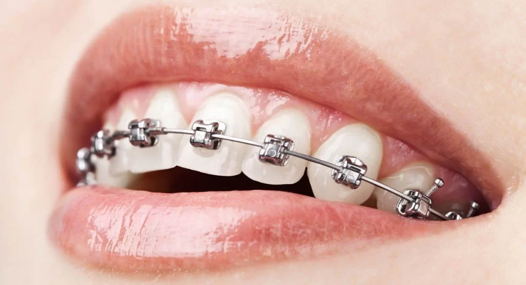 Braces & Aligners